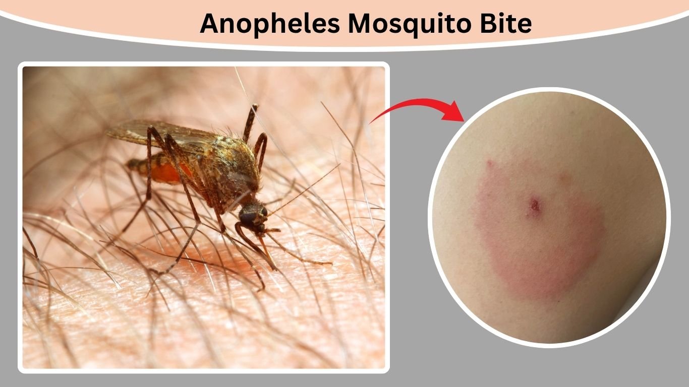 25 Types Of Insects Bites: Identification, Symptom with Pictures