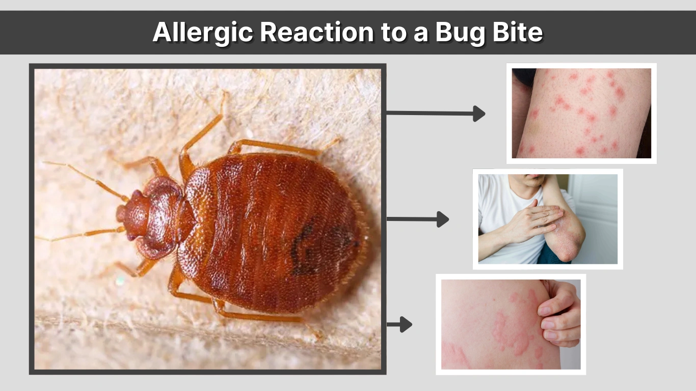 Allergic Reaction to a Bug Bite: Symptoms, Treatment, and Prevention