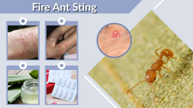 Fire Ant Sting Symptoms Reaction Treatment And Relief