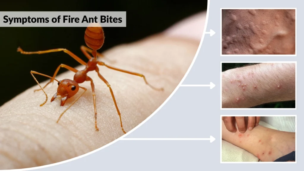Fire Ant Bites Identification Symptoms And Effective Treatments