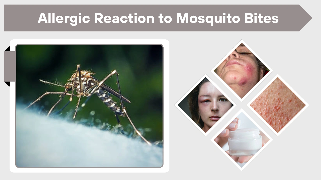 Allergic Reaction to Mosquito Bites: Symptoms, Treatment & Care