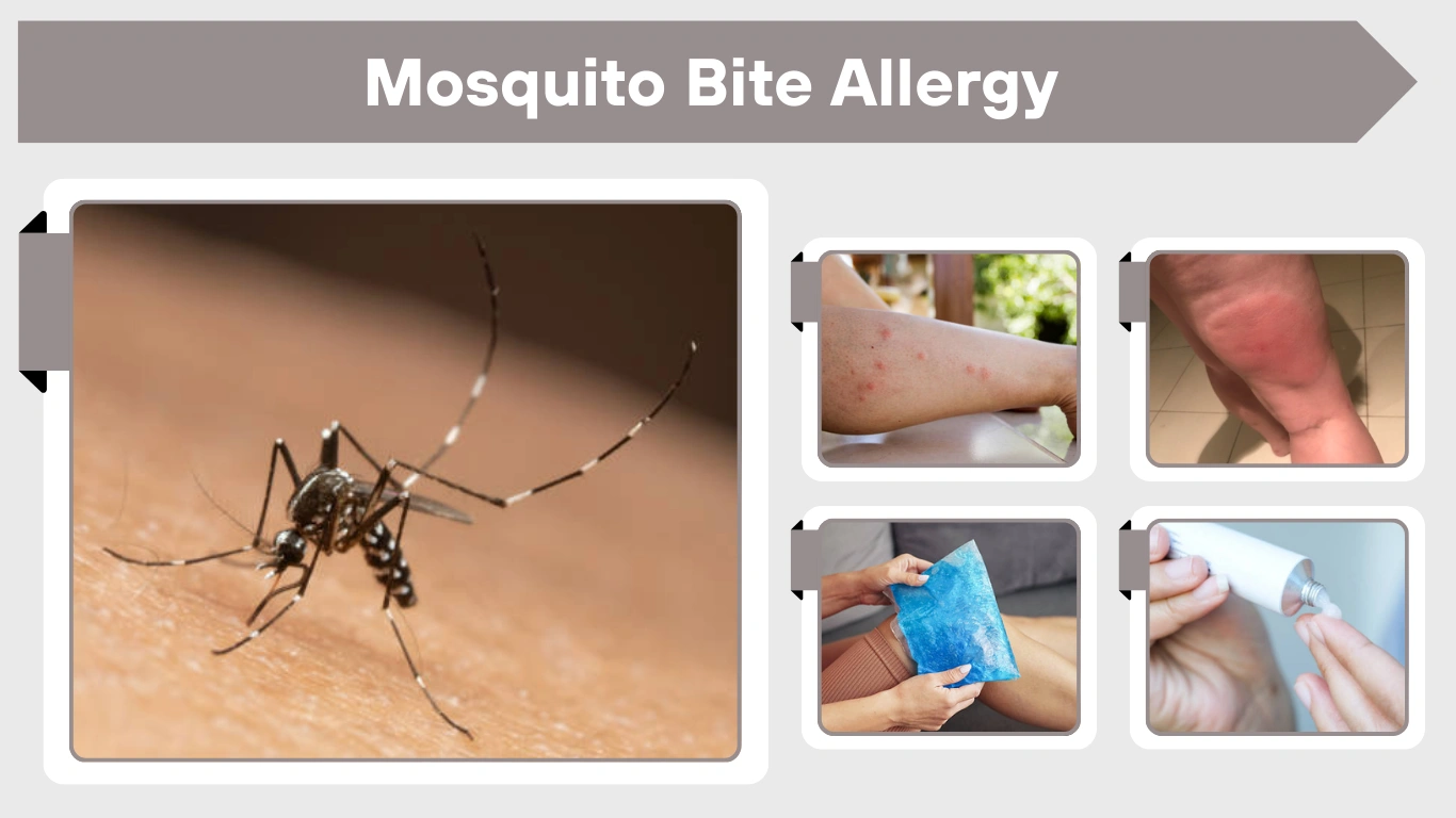 Mosquito Bite Allergy Symptoms, Pictures & Treatment