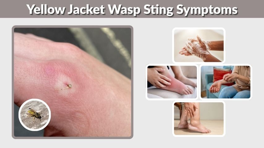 Yellow Jacket Wasp Sting Symptoms and Treatment Guide