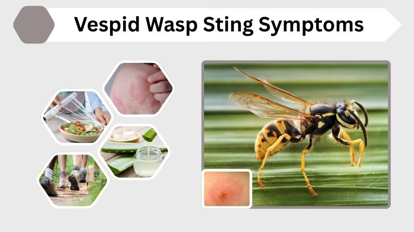Vespid Wasp Sting Symptoms, Pain, Allergies and Treatment Guide