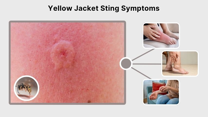 Yellow Jacket Sting Symptoms