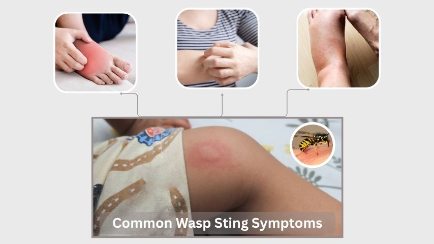 Common Wasp Sting Symptoms