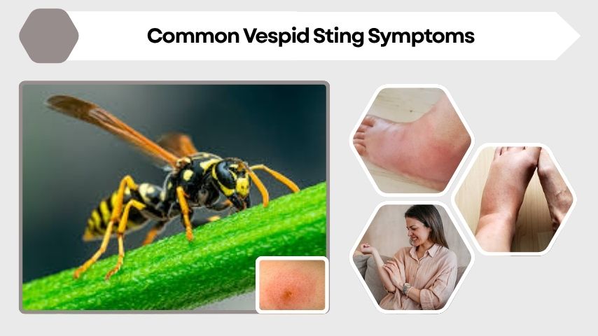 Common Vespid Sting Symptoms