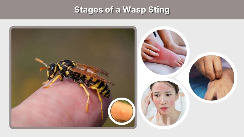 Stages of a Wasp Sting