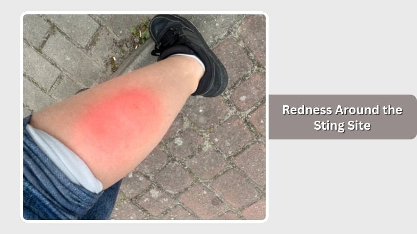 Redness Around the Sting Site