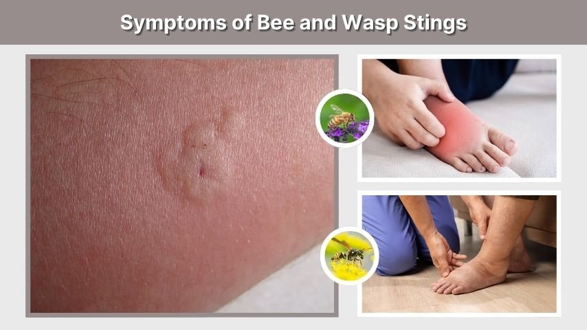 Symptoms of Bee and Wasp Stings