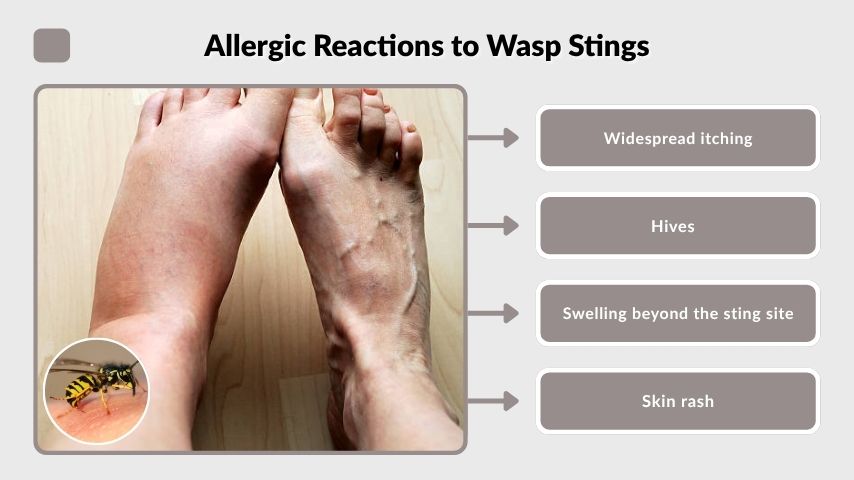 Allergic Reactions to Wasp Stings