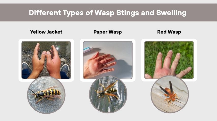 Different Types of Wasp Stings and Swelling