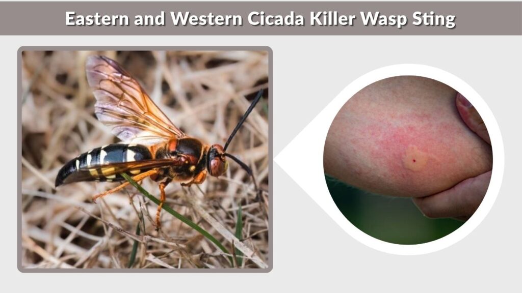 Eastern and Western Cicada Killer Wasp Sting