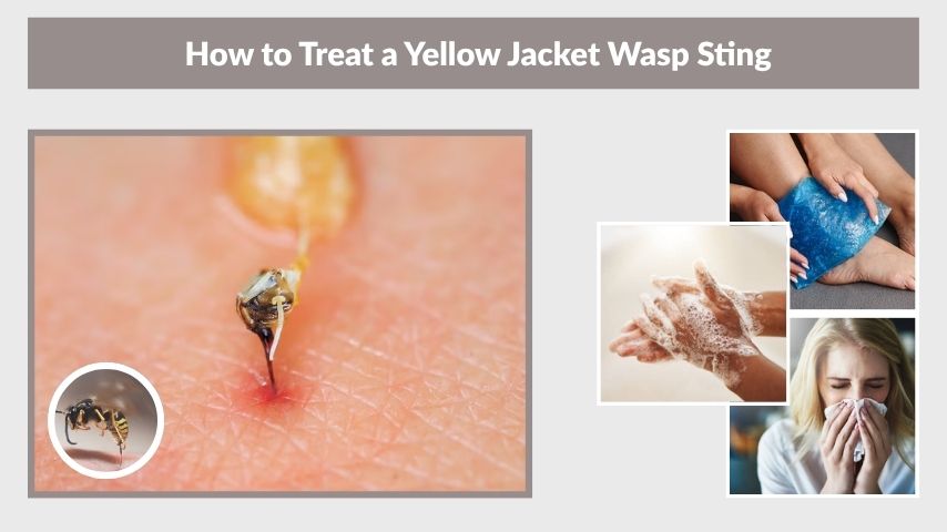 How to Treat a Yellow Jacket Wasp Sting
