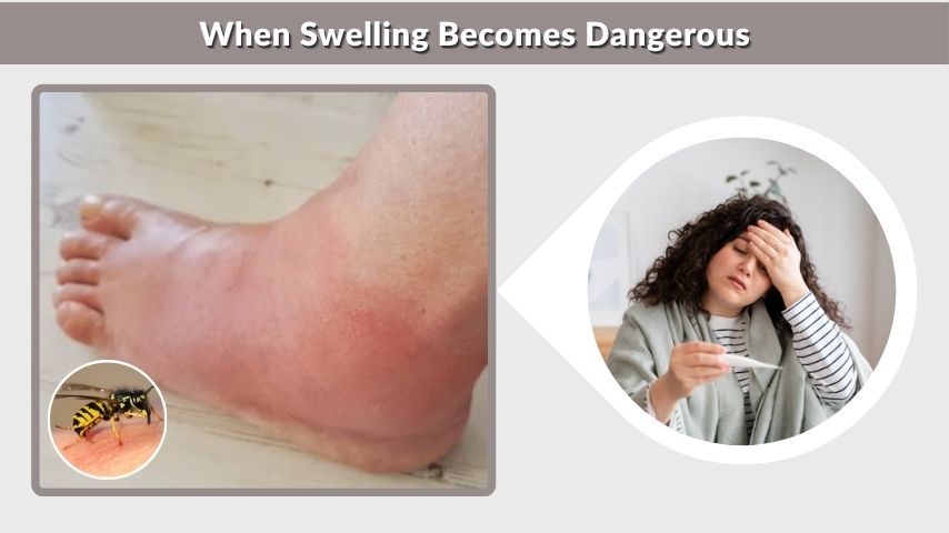 When Swelling Becomes Dangerous