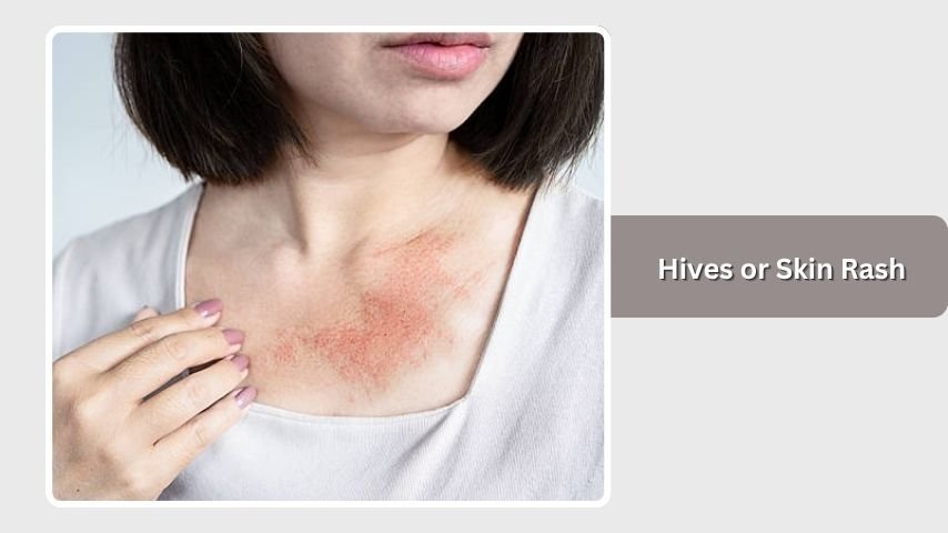 Hives or Skin Rash