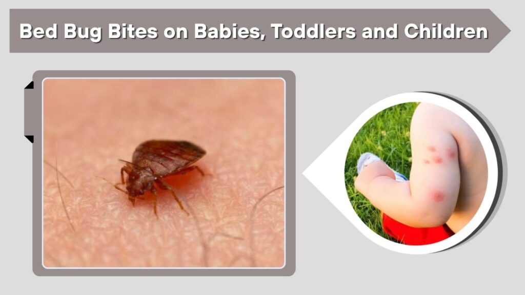 Bed Bug Bites on Babies, Toddlers and Children
