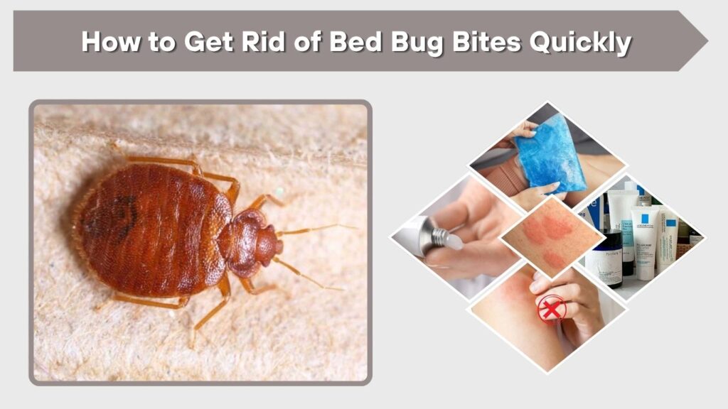 How to Get Rid of Bed Bug Bites Quickly