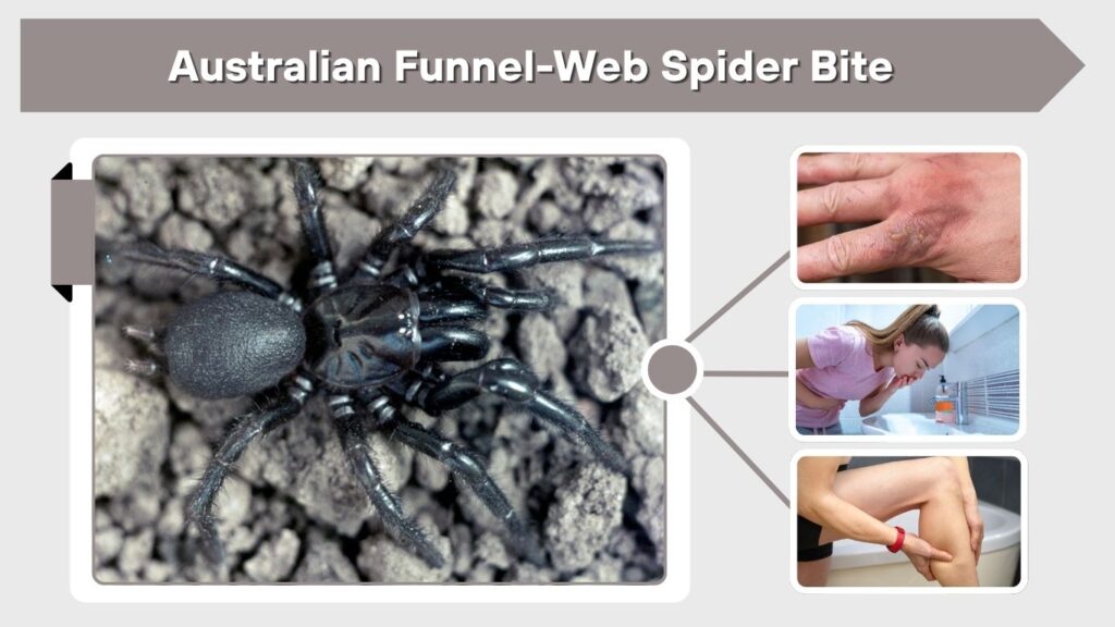 Australian Funnel-Web Spider Bite