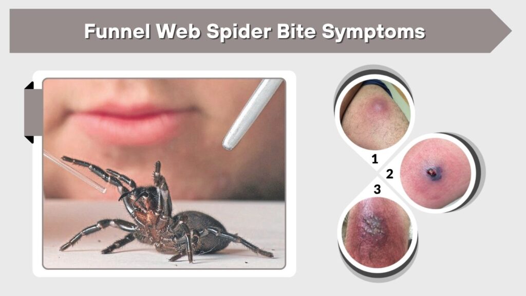 Funnel Web Spider Bite Symptoms