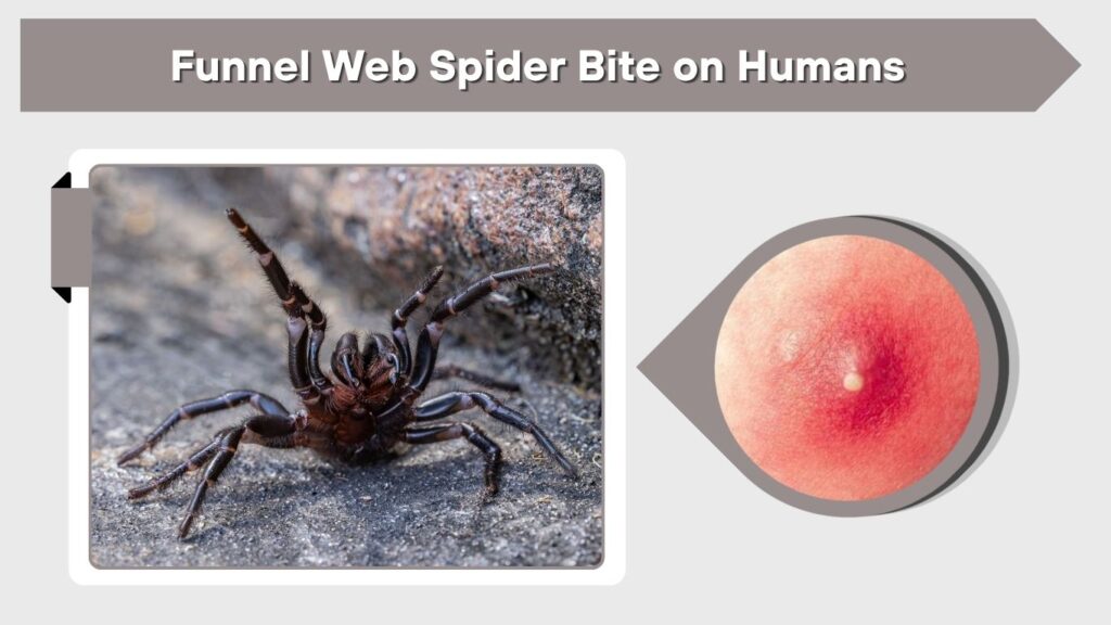 Funnel Web Spider Bite on Humans