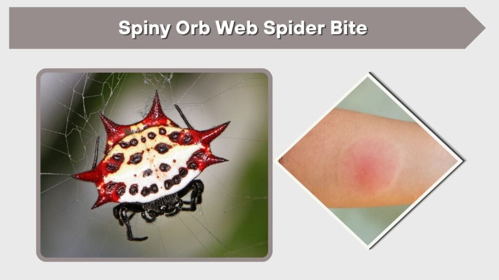 Spiny Orb Web Spider Bite