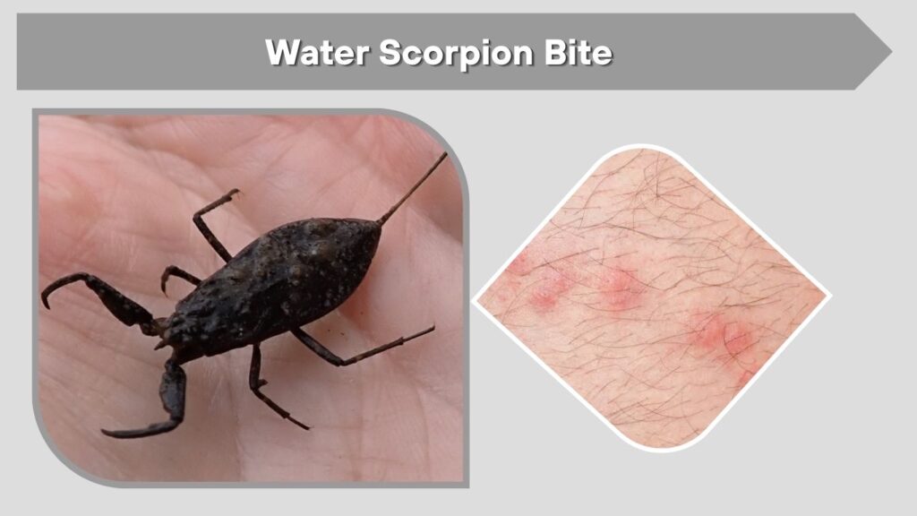 Water Scorpion Bite