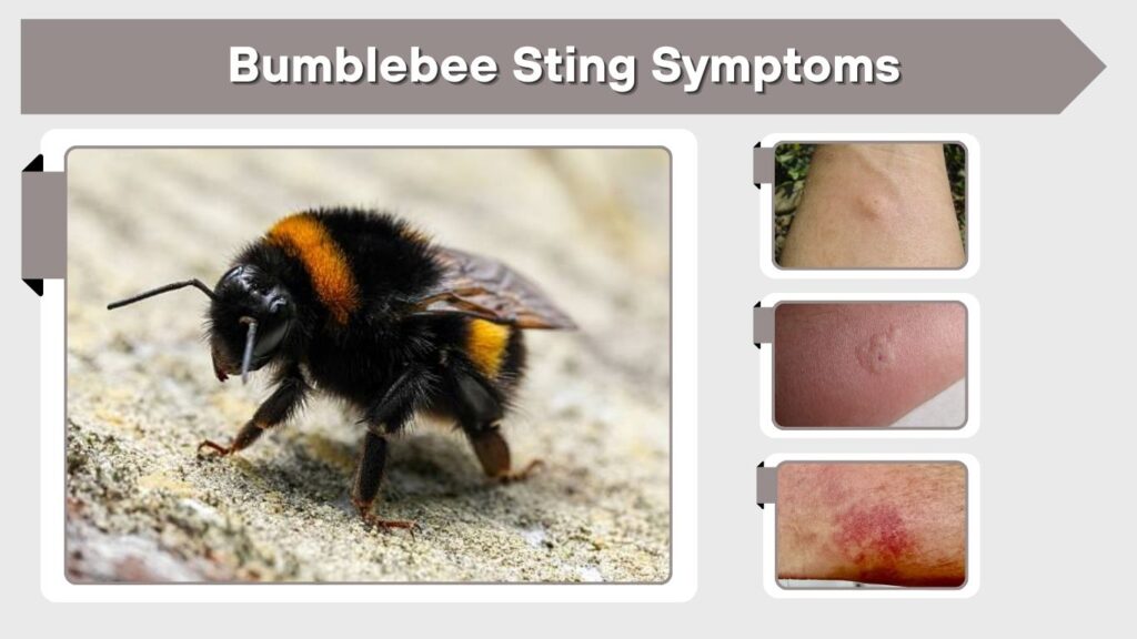 Bumblebee Sting Symptoms