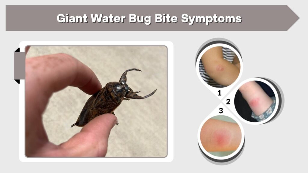 Giant Water Bug Bite Symptoms