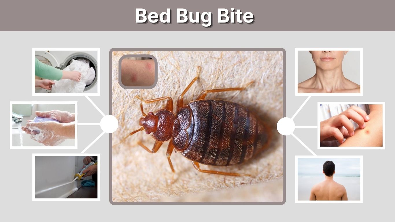 Bed Bug Bite: Causes, Symptoms, Treatment and Prevention