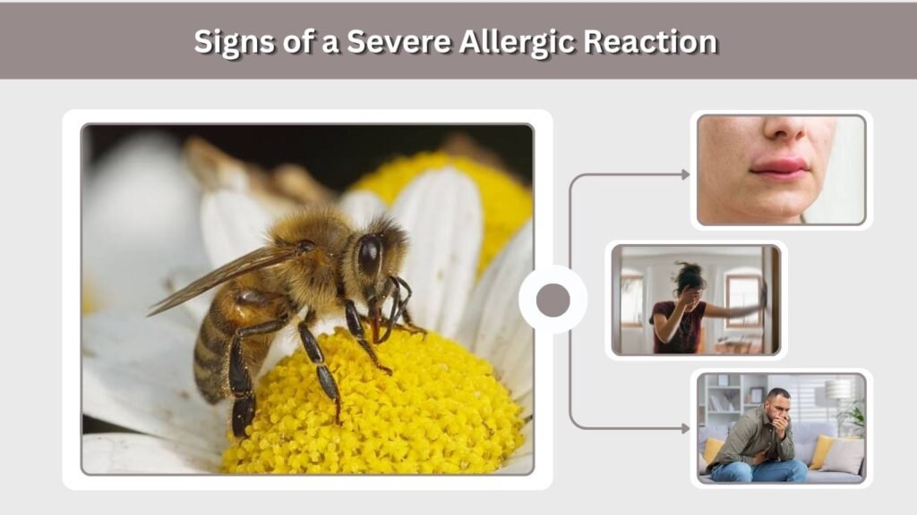 Signs of a Severe Allergic Reaction
