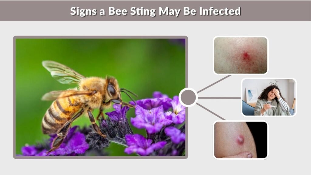 Signs a Bee Sting May Be Infected
