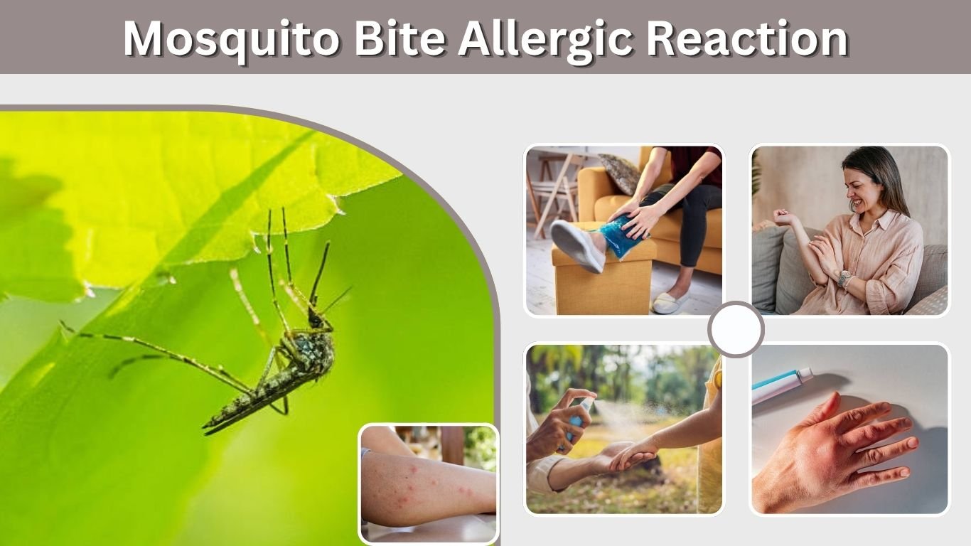 Mosquito Bite Allergic Reaction: Symptoms, Swelling & Treatment
