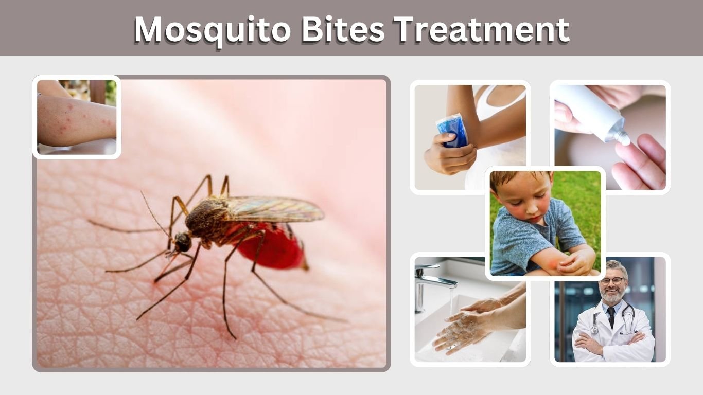 Mosquito Bites Treatment: Best Ways to Stop Itching and Swelling