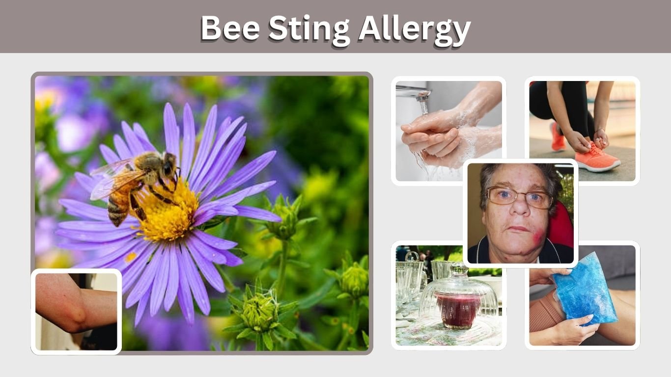 Bee Sting Allergy: Symptoms, Treatment, and Safety Tips