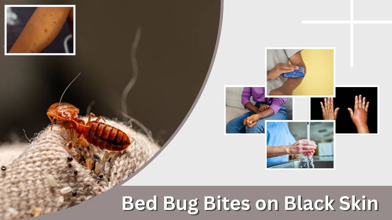 Bed Bug Bites on Black Skin: Signs, Symptoms & Treatment