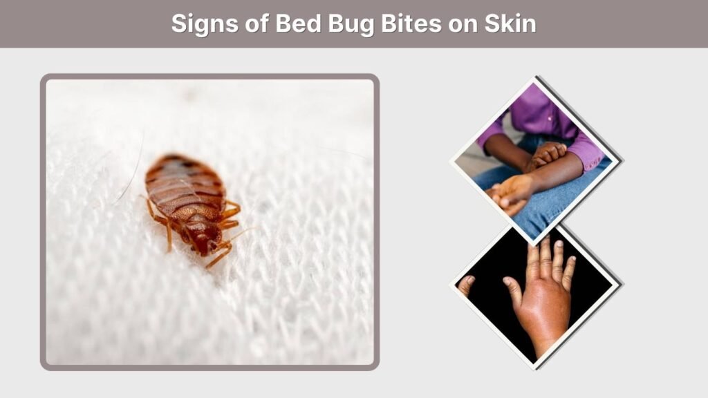 Signs of Bed Bug Bites on Skin