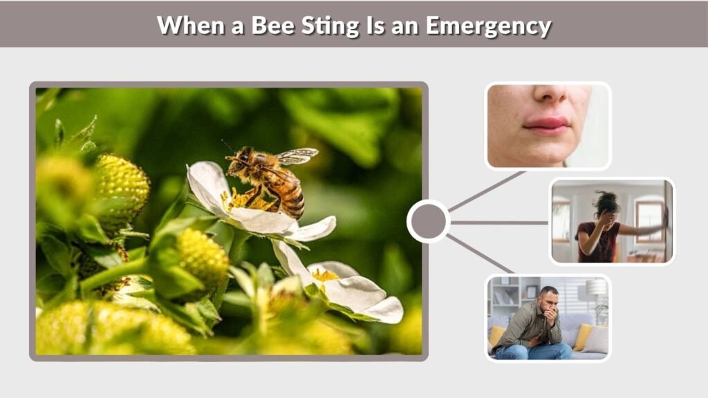 When a Bee Sting Is an Emergency