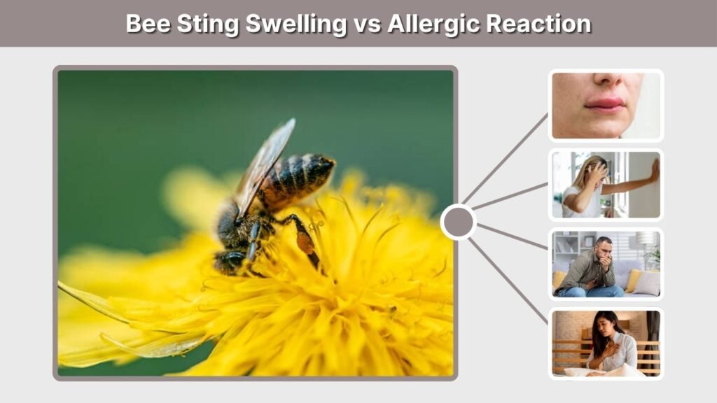 Bee Sting Swelling vs Allergic Reaction
