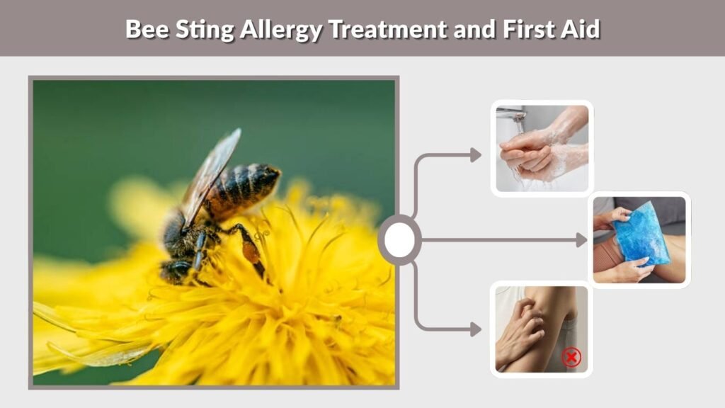 Bee Sting Allergy Treatment and First Aid