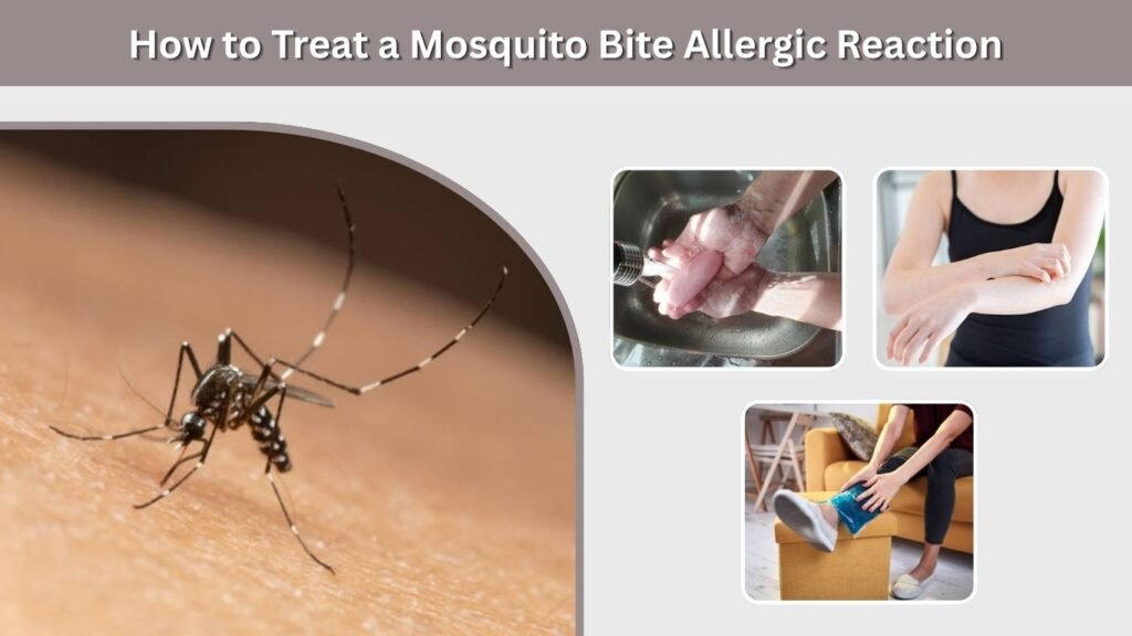 How to Treat a Mosquito Bite Allergic Reaction