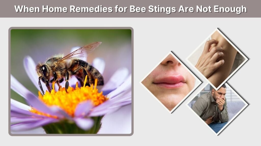 When Home Remedies for Bee Stings Are Not Enough