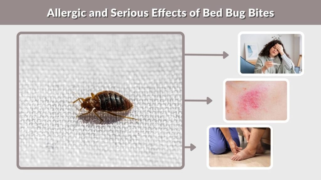 Allergic and Serious Effects of Bed Bug Bites