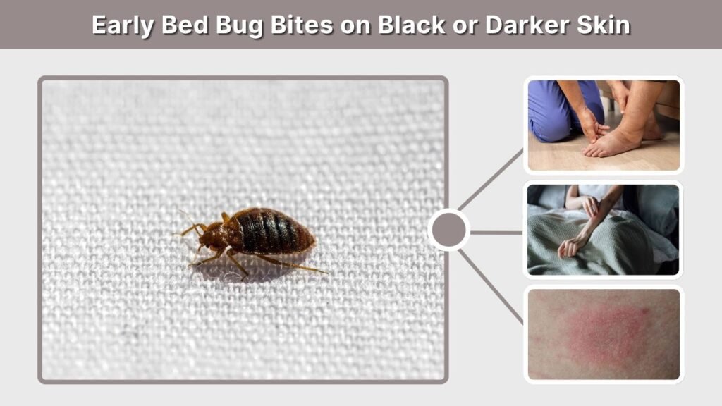 Early Bed Bug Bites on Black or Darker Skin